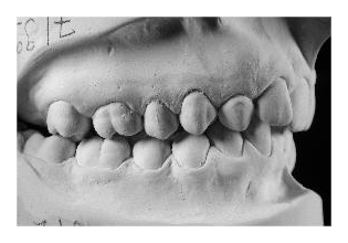 Eckzahnretention (Korrektur von Zahnfehlstellung und Kieferfehlstellung bei Erwachsenen)
