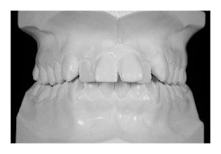 Frontzahnstufe (Korrektur von Zahnfehlstellung und Kieferfehlstellung bei Erwachsenen)