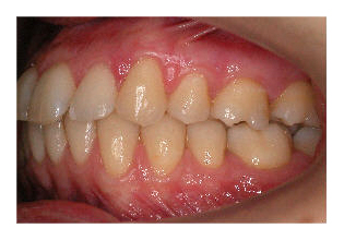 Frontzahnstufe (Korrektur von Zahnfehlstellung und Kieferfehlstellung bei Erwachsenen)