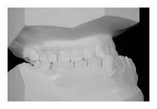 Kombiniert kieferorthopädisch-kieferchirurgische Behandlung (Korrektur von Zahnfehlstellung und Kieferfehlstellung bei Erwachsenen)