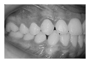 Deformierte Frontzähne (Korrektur von Zahnfehlstellung und Kieferfehlstellung bei Kindern & Jugendlichen)