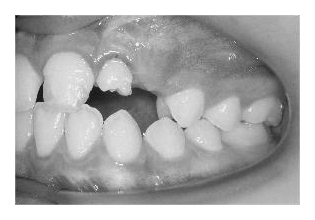 Deformierte Frontzähne (Korrektur von Zahnfehlstellung und Kieferfehlstellung bei Kindern & Jugendlichen)