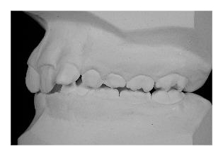 Eckzahnverlagerung (Korrektur von Zahnfehlstellung und Kieferfehlstellung bei Kindern & Jugendlichen)