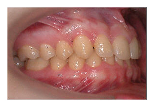 Eckzahnverlagerung (Korrektur von Zahnfehlstellung und Kieferfehlstellung bei Kindern & Jugendlichen)