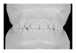 Frontzahnextraktion im Unterkiefer (Korrektur von Zahnfehlstellung und Kieferfehlstellung bei Kindern & Jugendlichen)
