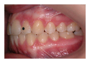 Frontzahnstufe (Korrektur von Zahnfehlstellung und Kieferfehlstellung bei Kindern & Jugendlichen)