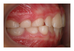 Frühbehandlung (Korrektur von Zahnfehlstellung und Kieferfehlstellung bei Kindern & Jugendlichen)