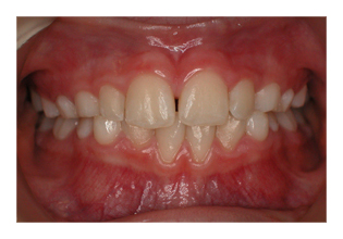 Frühbehandlung (Korrektur von Zahnfehlstellung und Kieferfehlstellung bei Kindern & Jugendlichen)