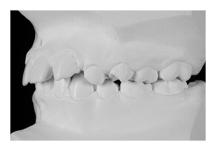 Nichtanlage eines seitlichen Schneidezahns (Korrektur von Zahnfehlstellung und Kieferfehlstellung bei Kindern & Jugendlichen)