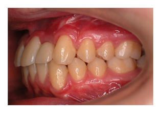 Nichtanlage eines seitlichen Schneidezahns (Korrektur von Zahnfehlstellung und Kieferfehlstellung bei Kindern & Jugendlichen)