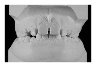 Seitenzahnverlagerung (Korrektur von Zahnfehlstellung und Kieferfehlstellung bei Kindern & Jugendlichen)