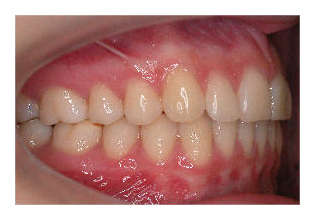 Seitenzahnverlagerung (Korrektur von Zahnfehlstellung und Kieferfehlstellung bei Kindern & Jugendlichen)