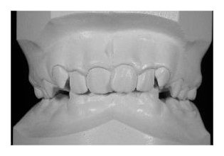 Tiefbiss (Korrektur von Zahnfehlstellung und Kieferfehlstellung bei Kindern & Jugendlichen)