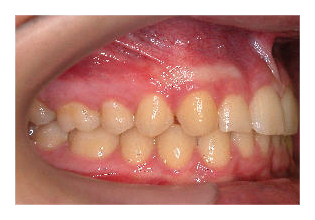 Tiefbiss (Korrektur von Zahnfehlstellung und Kieferfehlstellung bei Kindern & Jugendlichen)