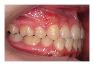 Umgekehrte Frontzahnstufe (Korrektur von Zahnfehlstellung und Kieferfehlstellung bei Kindern & Jugendlichen)