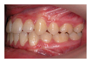 Umgekehrte Frontzahnstufe (Korrektur von Zahnfehlstellung und Kieferfehlstellung bei Kindern & Jugendlichen)