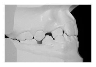 Zahnextraktionen I (Korrektur von Zahnfehlstellung und Kieferfehlstellung bei Kindern & Jugendlichen)