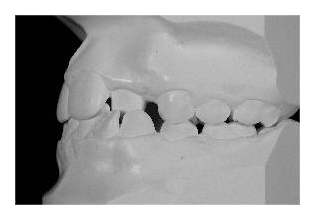 Zahnextraktionen I (Korrektur von Zahnfehlstellung und Kieferfehlstellung bei Kindern & Jugendlichen)