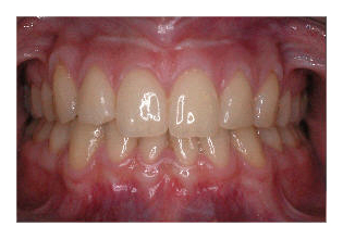 Zahnextraktionen II (Korrektur von Zahnfehlstellung und Kieferfehlstellung bei Kindern & Jugendlichen)