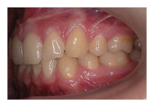 Zahnextraktionen II (Korrektur von Zahnfehlstellung und Kieferfehlstellung bei Kindern & Jugendlichen)