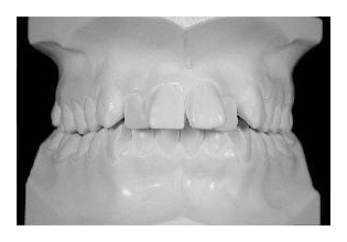 Korrektur von Zahnfehlstellung und Kieferfehlstellung bei Erwachsenen