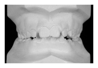 Korrektur von Zahnfehlstellung und Kieferfehlstellung bei Kindern & Jugendlichen